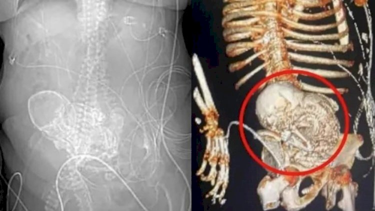 Grávida há mais de 50 anos, idosa descobre feto calcificado em abdômen